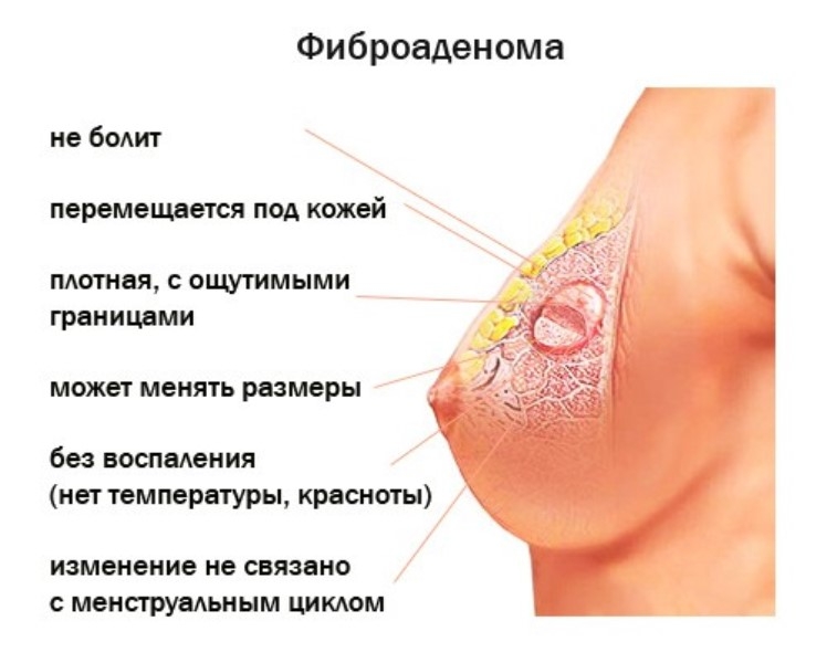 фиброаденома молочной железы