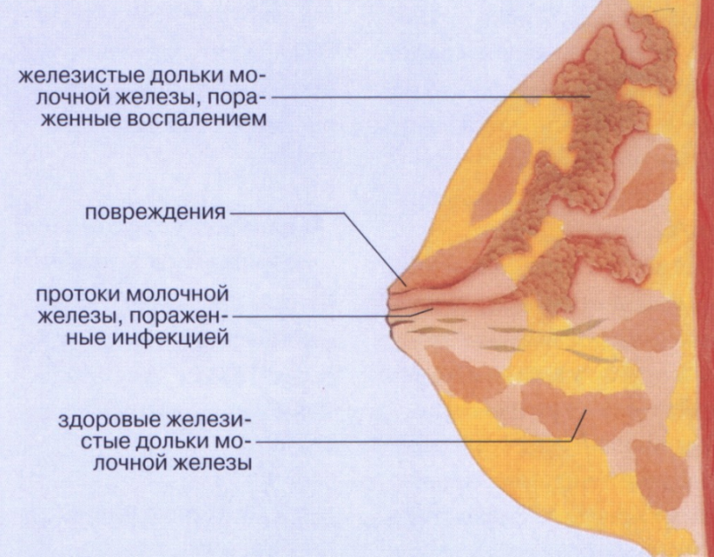 Мастит