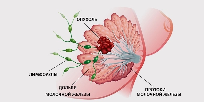 рак молочной железы 1 стадии